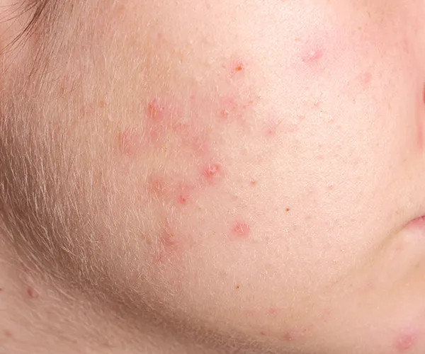 Salicylic acid Acne