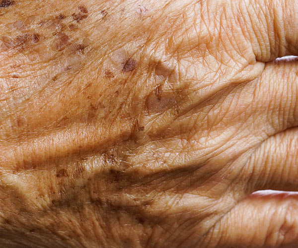 close up age spots hands