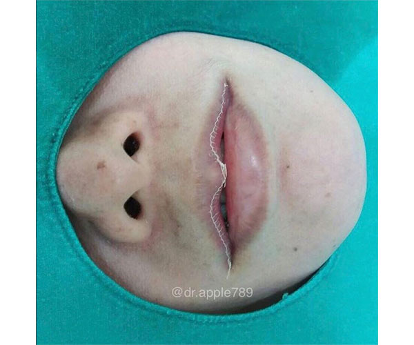 lip reduction surgery