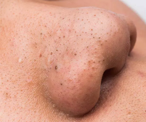Nose Blackheads