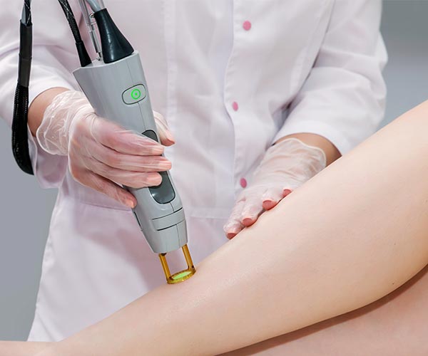 laser hair removal