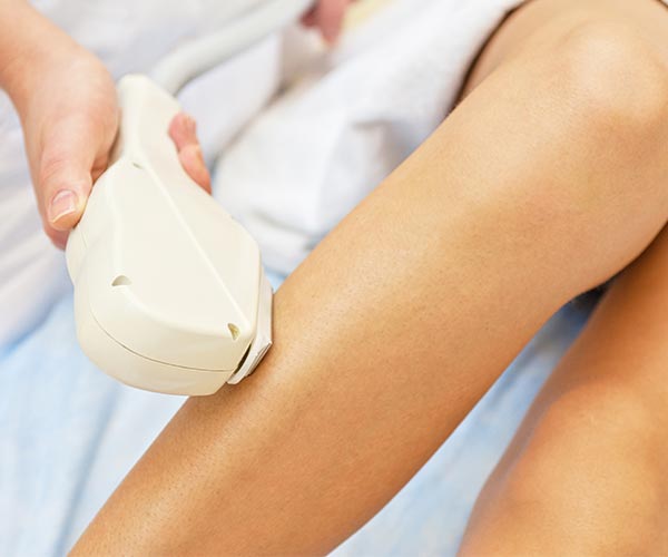 laser hair removal