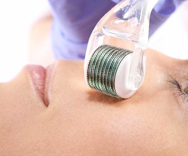 microneedling procedure