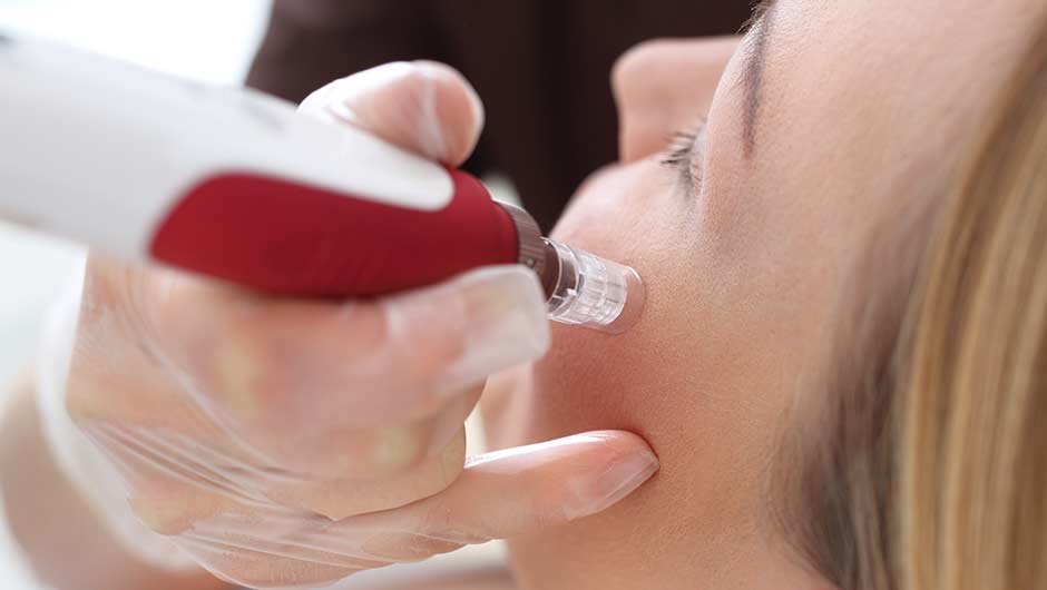 microneedling procedure