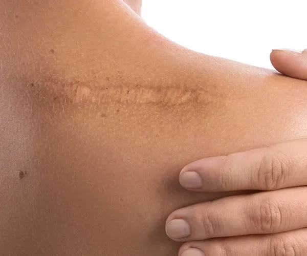 Scarring Image from SHEfinds