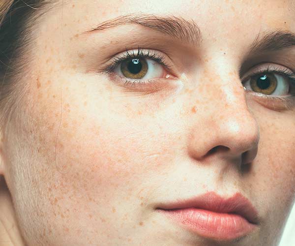 freckles skin health
