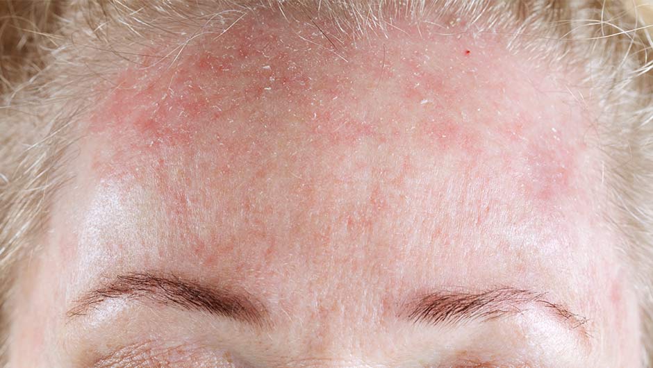 6 AtHome Remedies For Dry Skin SHEfinds