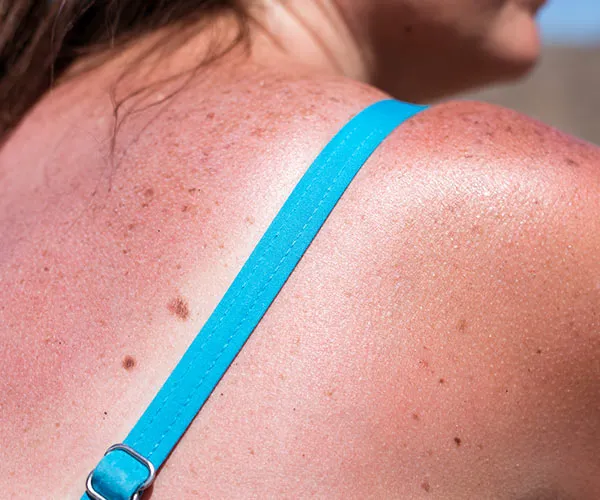 woman sunburn