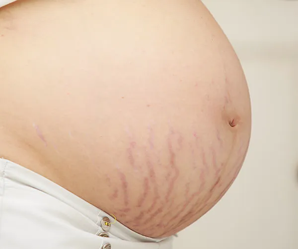 stretch marks