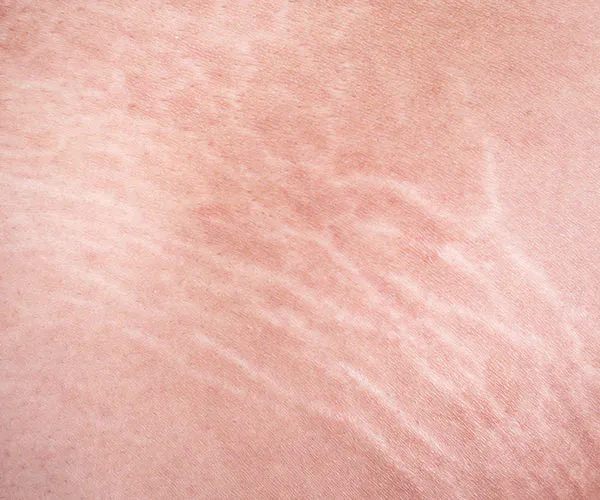 stretch marks