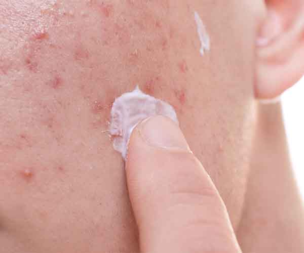 Three Times A Day Makes Your Zit Go Away woman applying zit cream