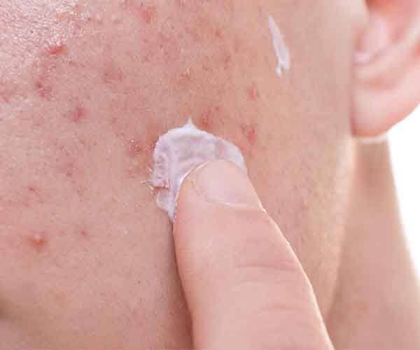 woman applying zit cream