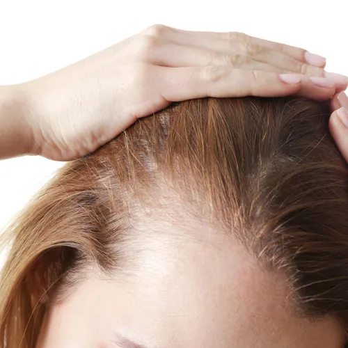 thinning red hair