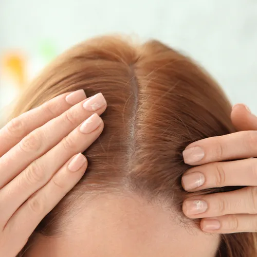 thinning red hair