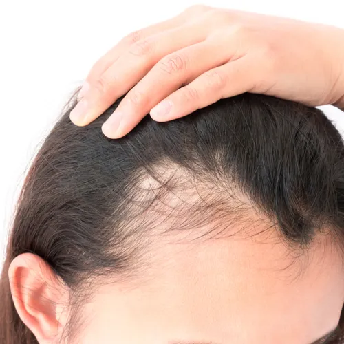 thinning hair