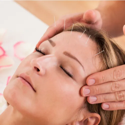 acupuncture