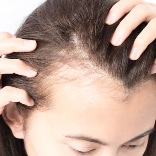 receding hair line