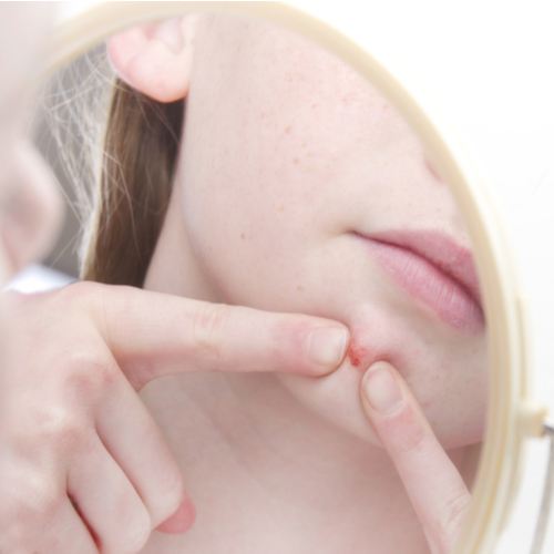 7 AtHome Remedies For When Zits Pop Up Out Of Nowhere, According To