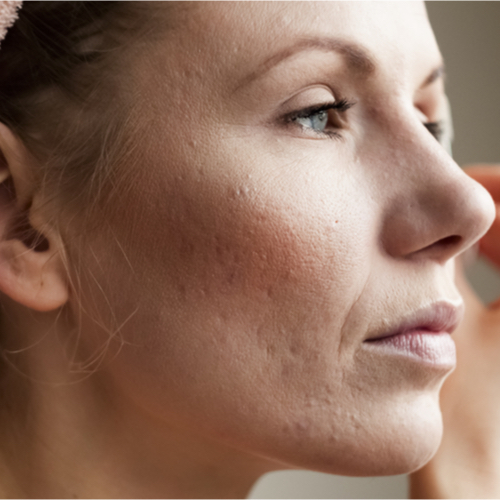 woman with acne scars