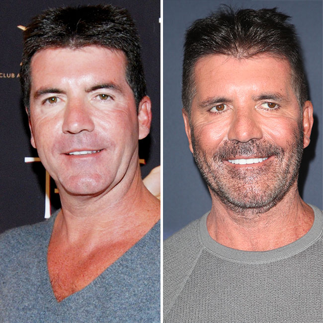 Simon Cowell before/after