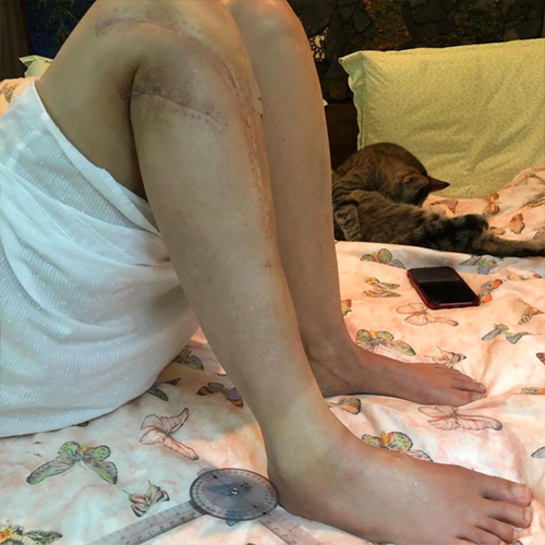 Ashley Judd leg injury