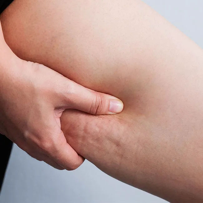 <h2>How To Treat & Prevent Cellulite</h2> best cellulite creams