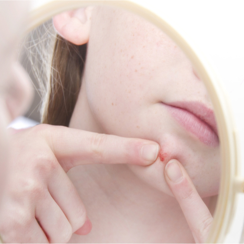 The Worst Mistake You Could Make When A Zit Pops Up Out Of Nowhere