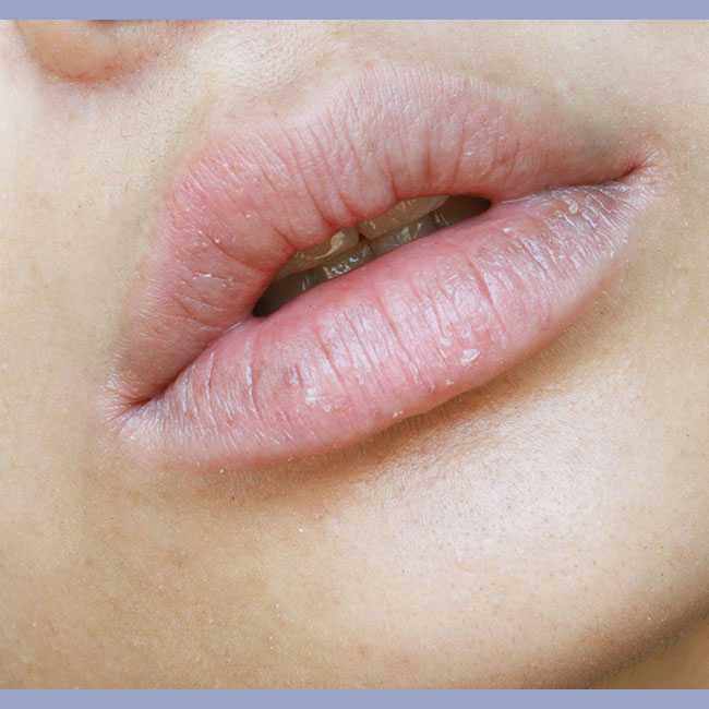 Does Anemia Cause Chapped Lips