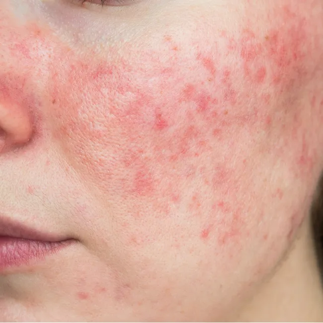 best vitamin combat Rosacea redness