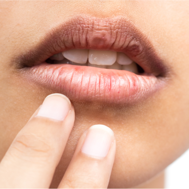 4 Expert-Approved Tips for Getting Rid of Dry, Chapped Lips This Winter
