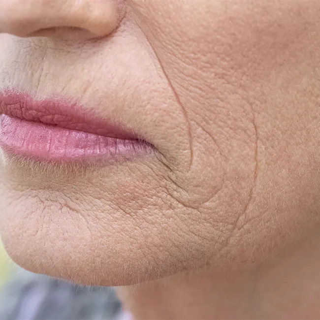 Close-up of smile lines and mouth wrinkles.
