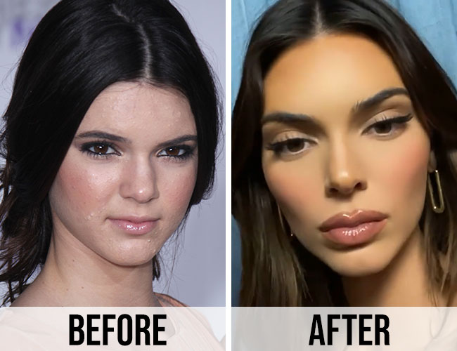 These Before And After Pics Of Kendall Jenner Are Insane—what Did She