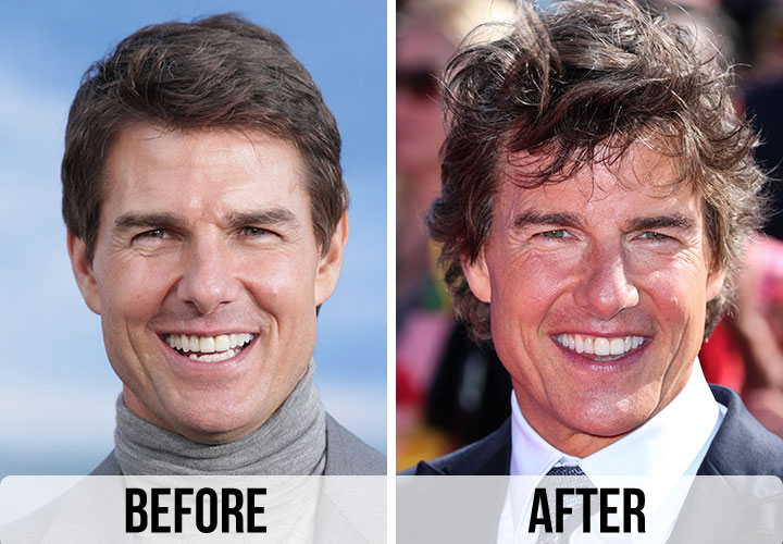 Tom Cruise before and after alleged plastic surgery Botox