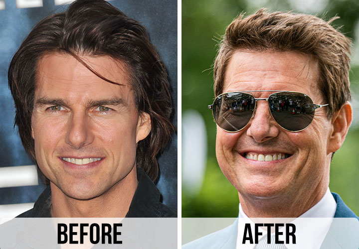Tom Cruise before and after alleged plastic surgery chin