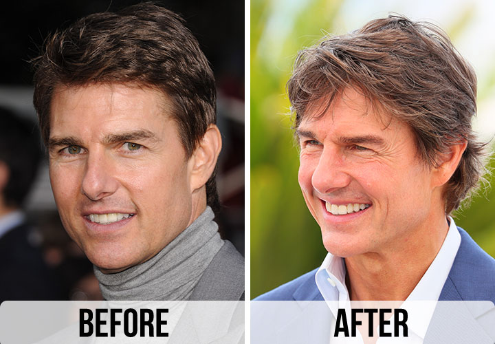 Tom Cruise before and after alleged plastic surgery