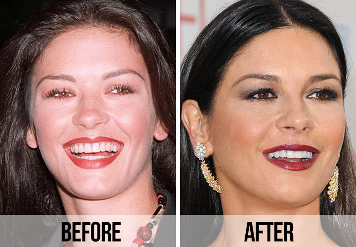 Catherine Zeta-Jones teeth before and after