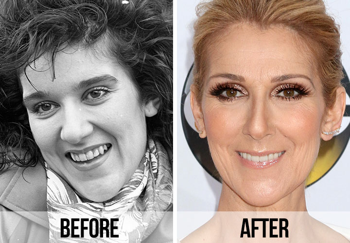 Celine Dion teeth before and after