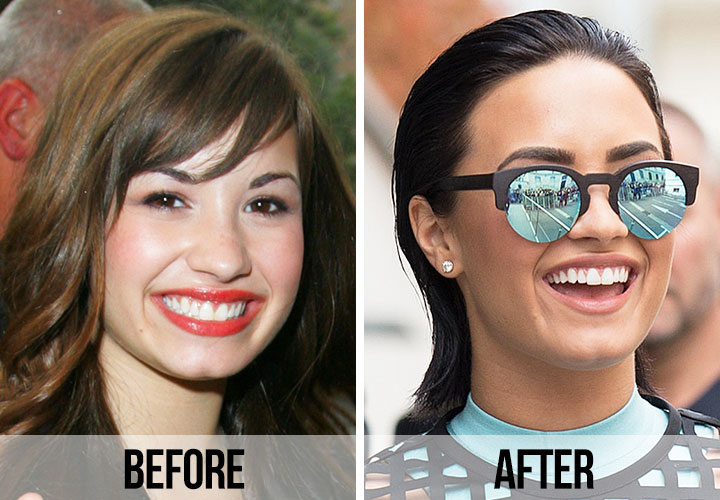 Demi Lovato teeth before and after