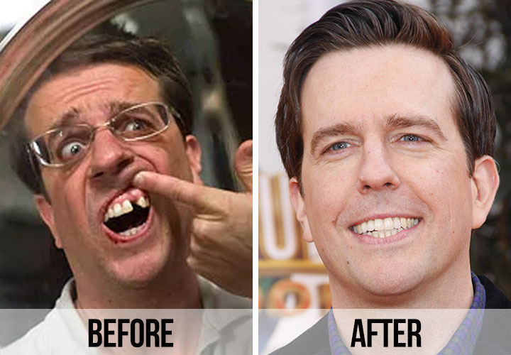 Ed Helms teeth before and after