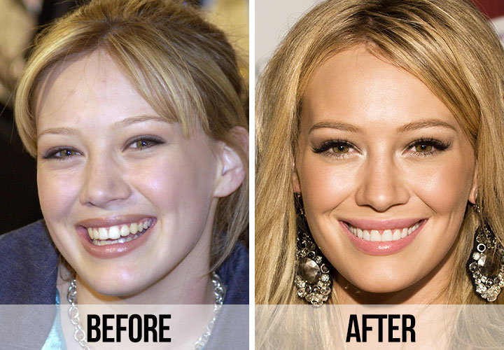 Hilary Duff teeth before and after