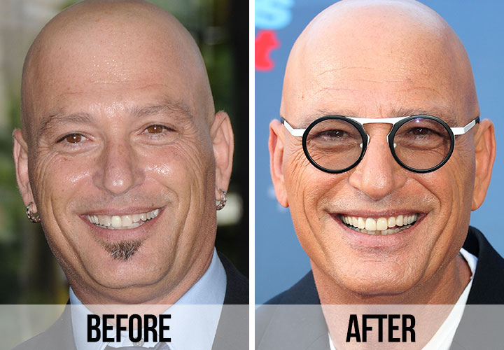 Howie Mandel teeth before and after