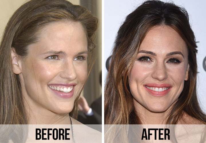Jennifer Garner teeth before and after