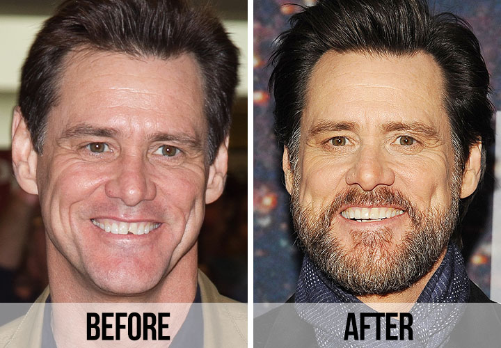 Jim Carrey teeth before and after