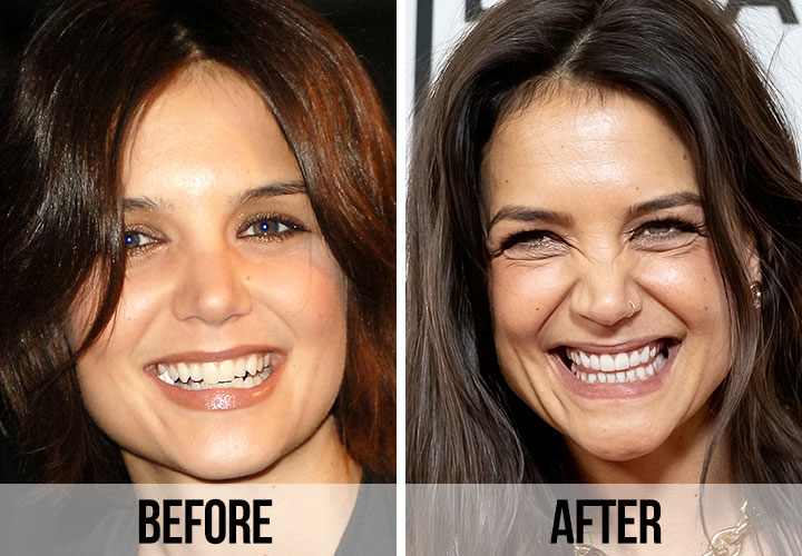 Katie Holmes teeth before and after