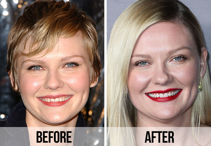 Kirsten Dunst teeth before and after