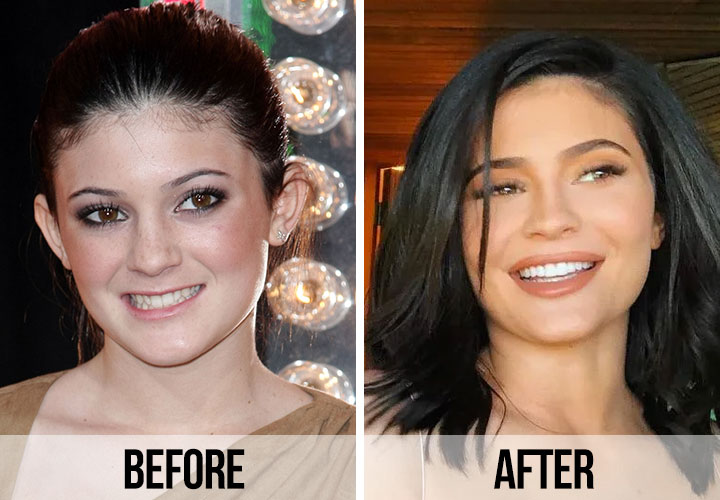 Kylie Jenner teeth before and after