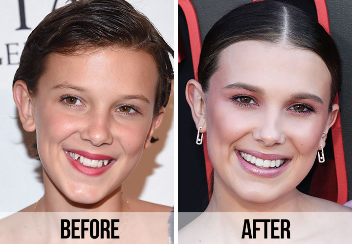 Millie Bobby Brown teeth before and after