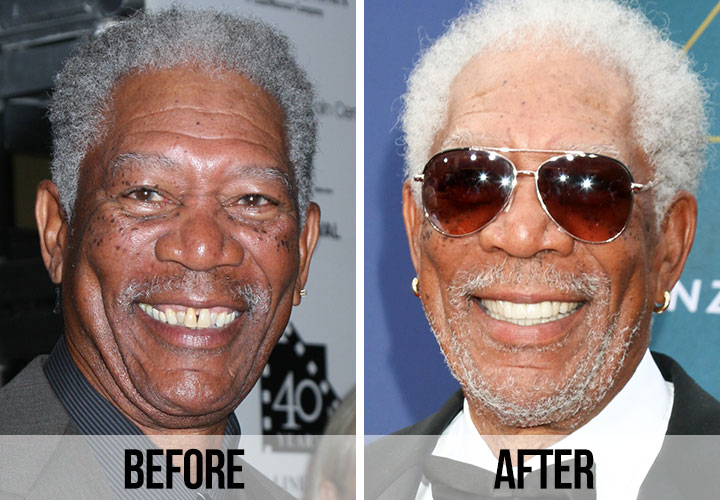 Morgan Freeman teeth before and after