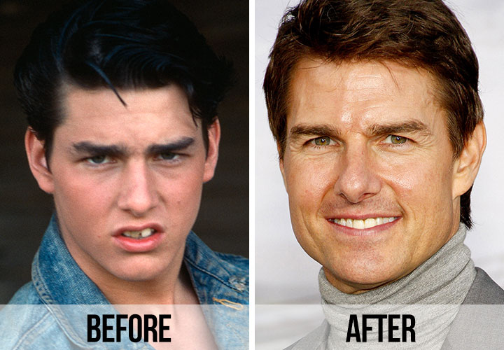 Tom Cruise teeth before and after