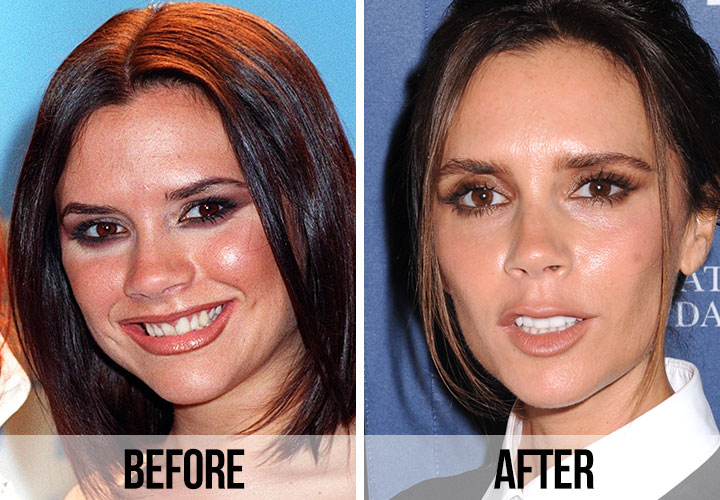 Victoria Beckham teeth before and after